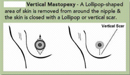 Vertical Mastopexy 