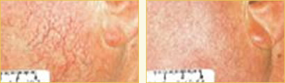 Vessel Reduction
