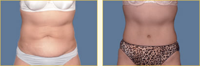Abdominoplasty (Tummy Tuck)