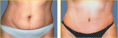 Abdominoplasty (Tummy Tuck)