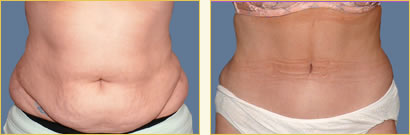Abdominoplasty (Tummy Tuck)