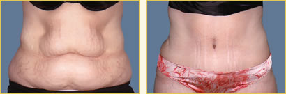 Abdominoplasty (Tummy Tuck)
