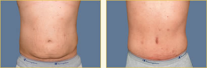 Abdominoplasty