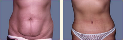 Abdominoplasty
