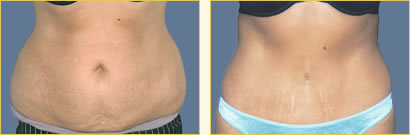 Abdominoplasty (Tummy Tuck)