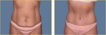 Abdominoplasty (Tummy Tuck)