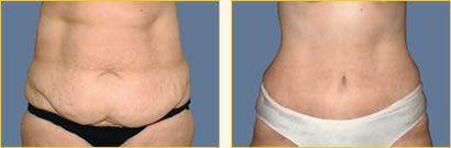 Abdominoplasty