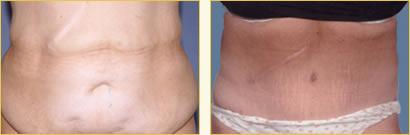 Abdominoplasty (Tummy Tuck)