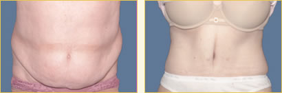 Abdominoplasty (Tummy Tuck)