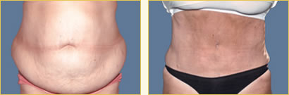 Abdominoplasty (Tummy Tuck)