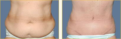 Abdominoplasty (Tummy Tuck)