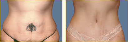 Abdominoplasty (Tummy Tuck)
