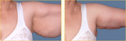 Brachioplasty