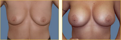 Breast Augmentation