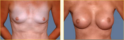 Breast Augmentation