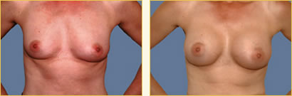 Breast Augmentation