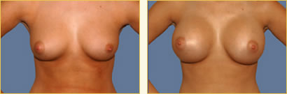 Breast Augmentation