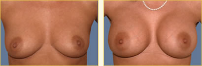Breast Augmentation