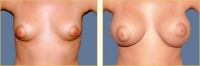 Breast Augmentation