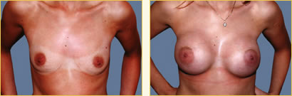 Breast Augmentation