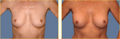 Breast Augmentation
