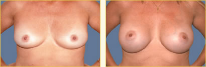 Breast Augmentation