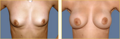 Breast Augmentation
