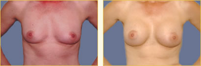 Breast Augmentation