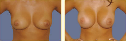 Breast Augmentation