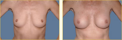 Breast Augmentation
