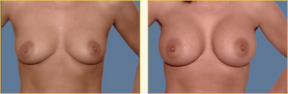 Breast Augmentation