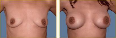 Breast Augmentation