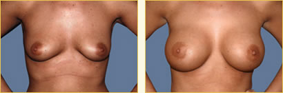 Breast Augmentation