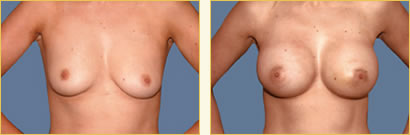 Breast Augmentation