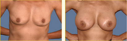 Breast Augmentation