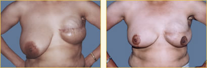 Breast Reconstruction