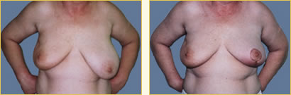 Breast Reconstruction