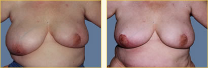 Breast Reconstruction