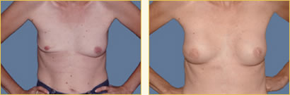 Breast Reconstruction Gallery
