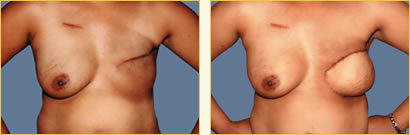 Breast Reconstruction