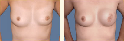 Breast Reconstruction