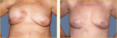 Breast Reconstruction