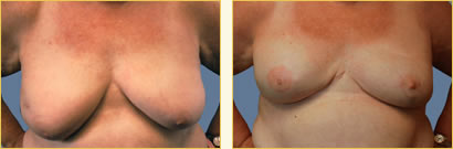 BrBreast Reconstruction