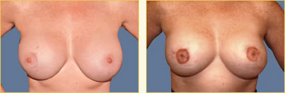 Breast Reconstruction