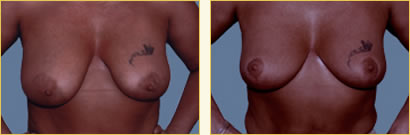 Breast Reduction