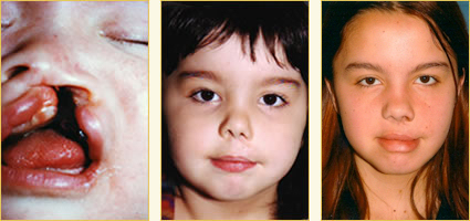 Cleft Lip Surgery 