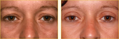 Eyelid Surgery