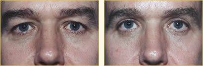 Eyelid Surgery