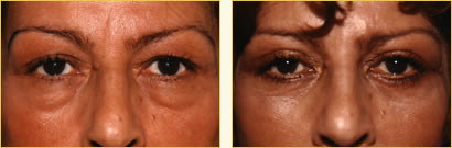 Eyelid Surgery