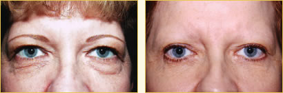 Eyelid Surgery